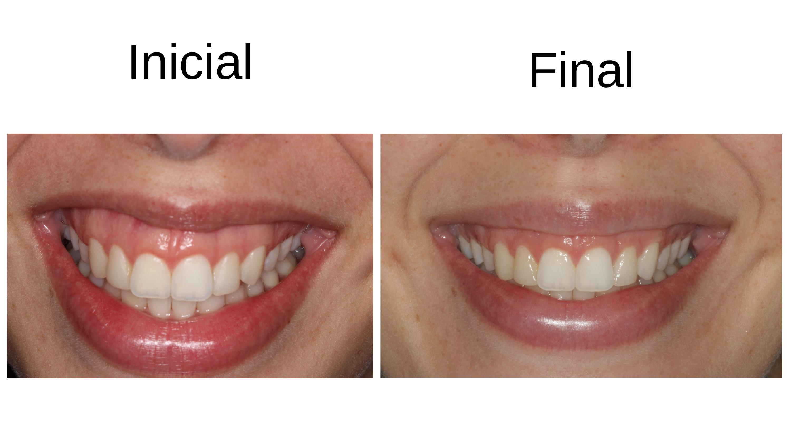 Caso clínico 6 — antes e depois do tratamento de sorriso gengival
