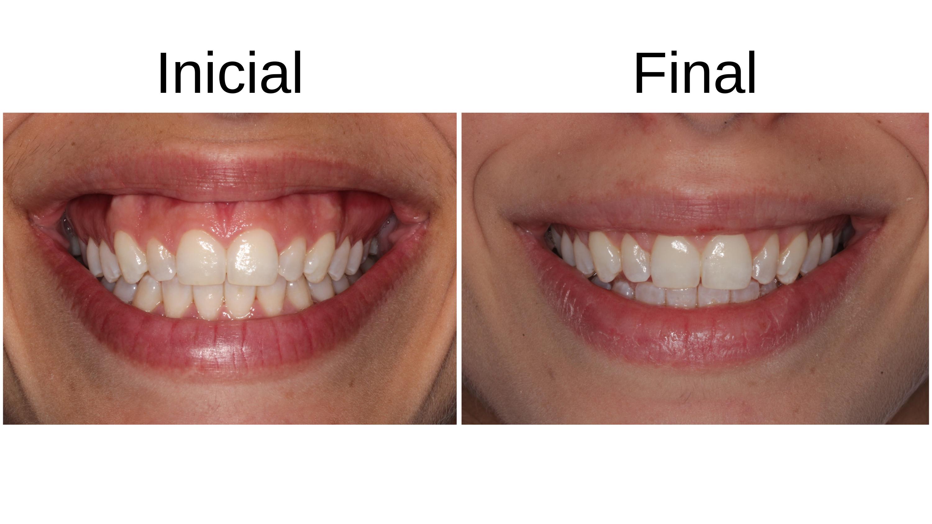 Caso clínico 3 — antes e depois do tratamento de sorriso gengival