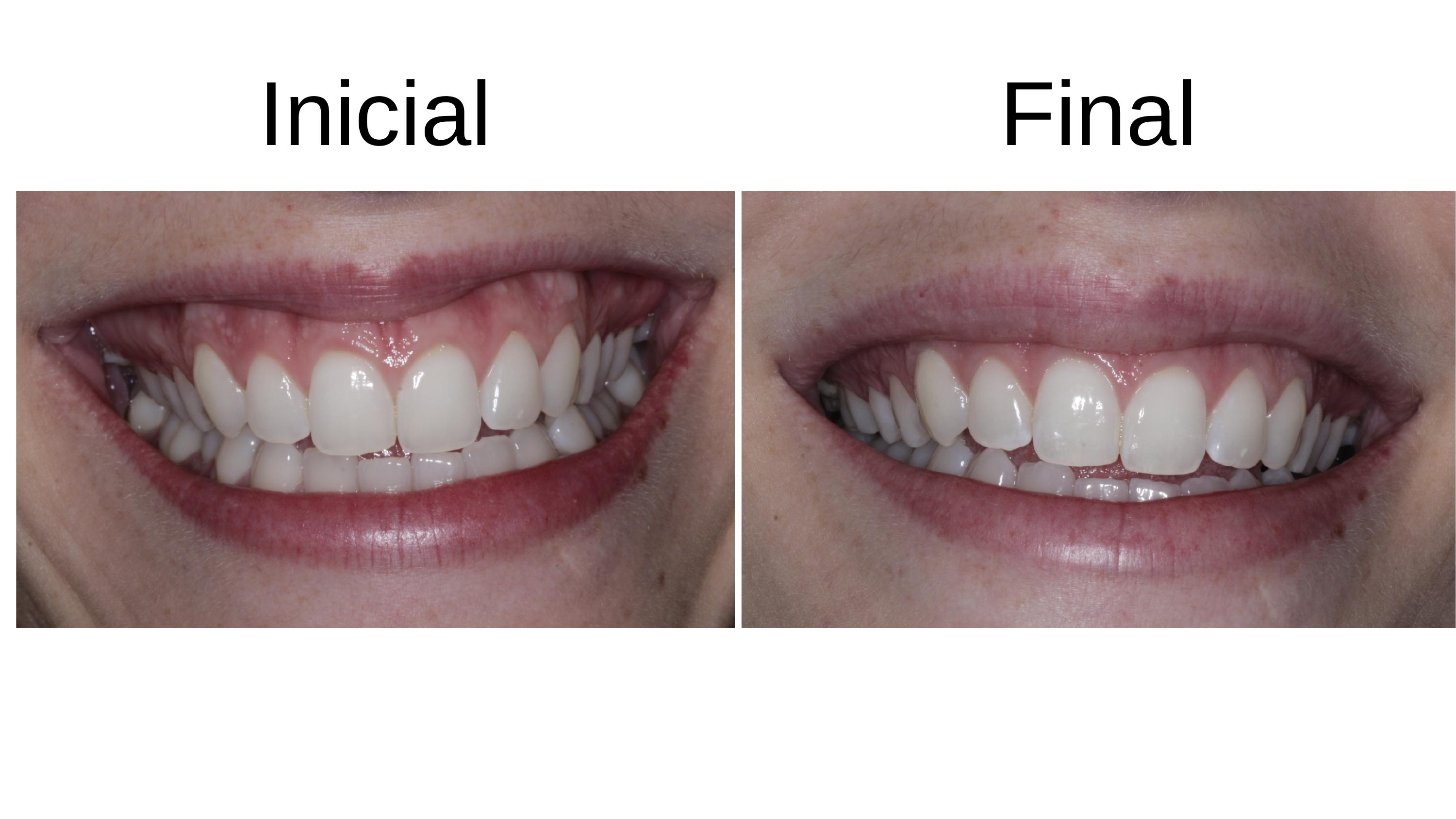 Caso clínico 8 — antes e depois do tratamento de sorriso gengival