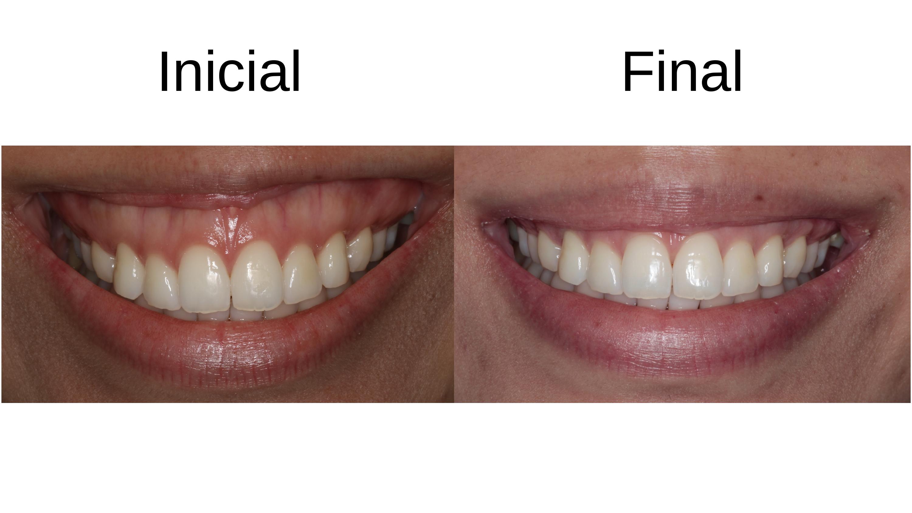 Caso clínico 7 — antes e depois do tratamento de sorriso gengival