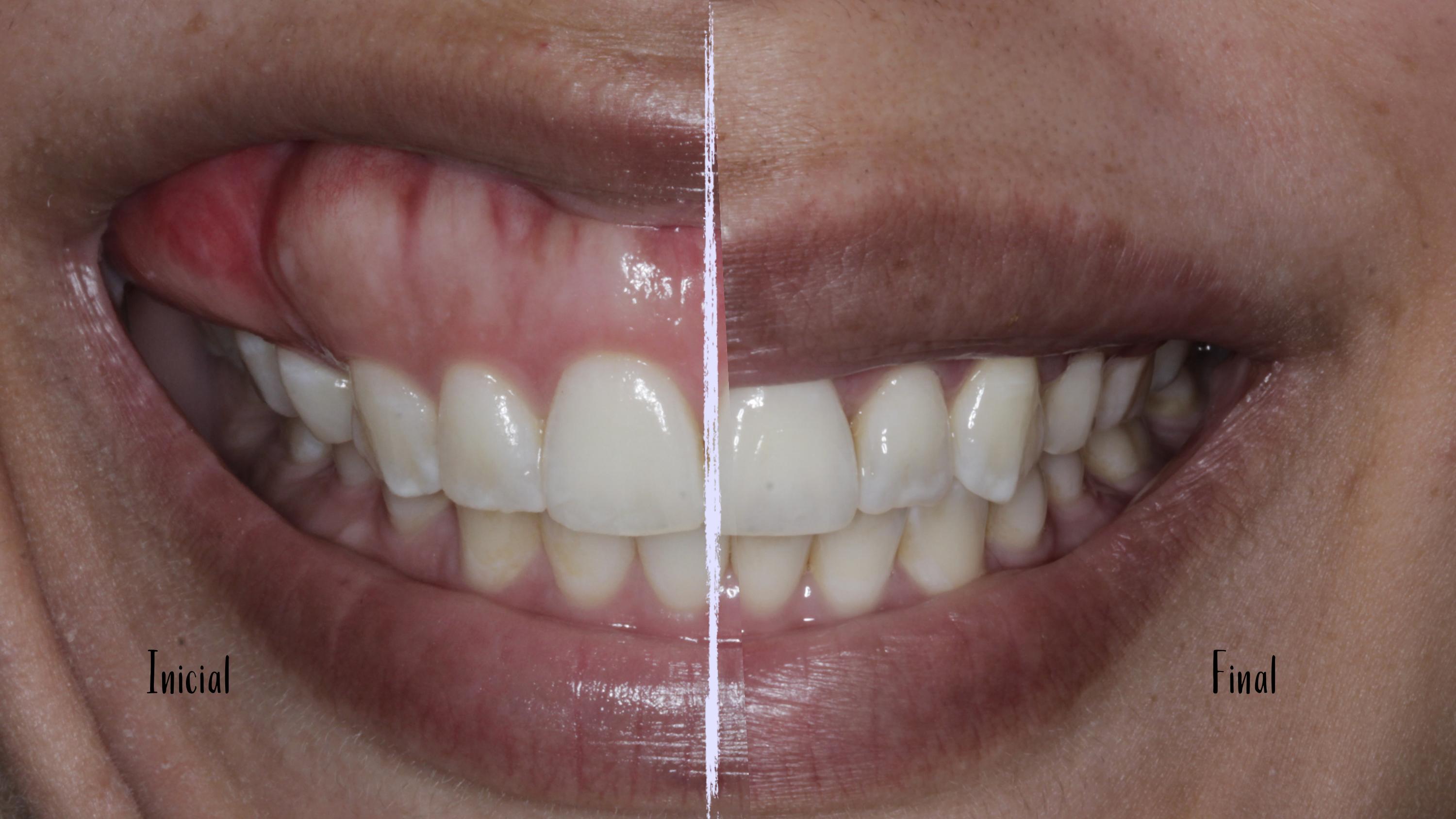 Caso clínico 1 — antes e depois do tratamento de sorriso gengival