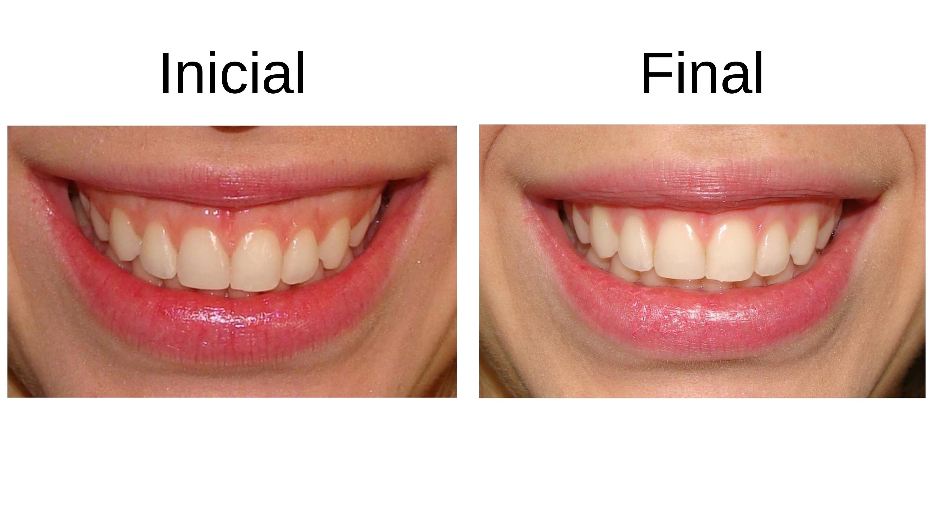 Caso clínico 5 — antes e depois do tratamento de sorriso gengival