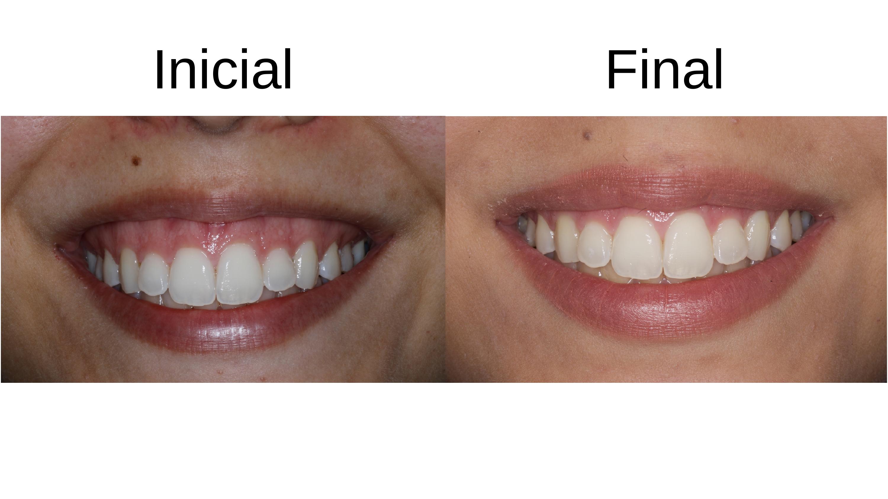 Caso clínico 4 — antes e depois do tratamento de sorriso gengival