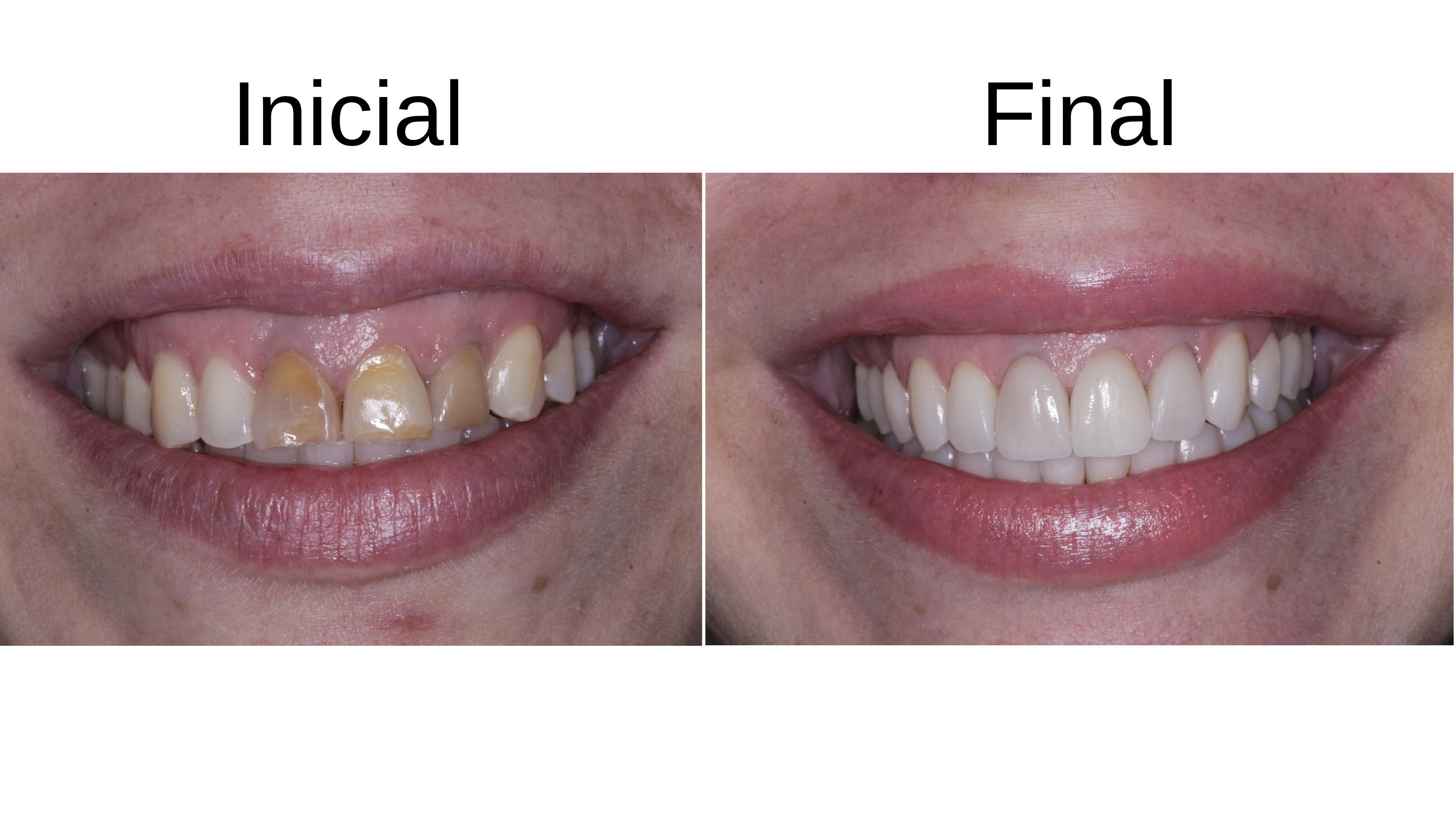 Caso clínico 2 — antes e depois do tratamento de sorriso gengival